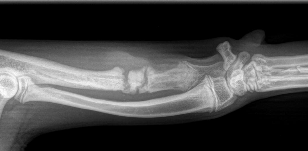 Short Ulna